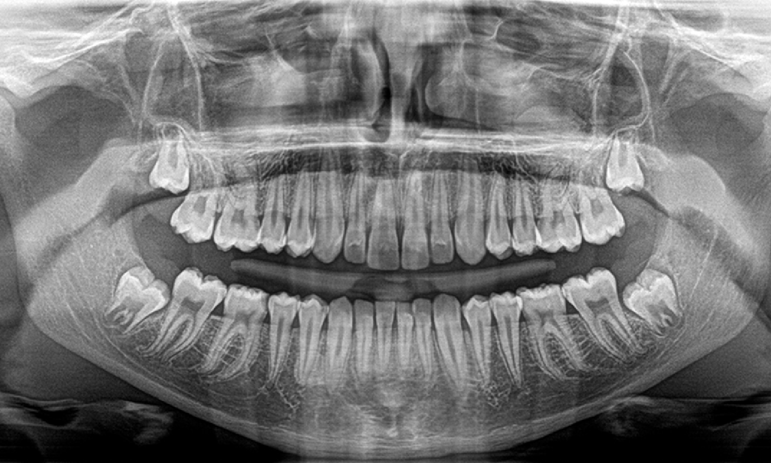 protocolos-para-cirurgia-guiada-de-implante-periodontia-e-endodontia-endoguide-ddi