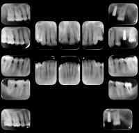 periapicais-exame-ddi-radiografia-odontologica