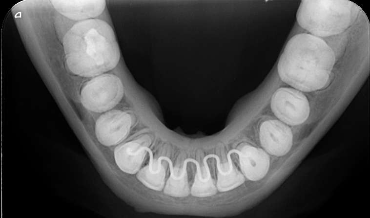 oclusal_supoclusal_inf-exame-oclusal-exame-ddi-radiografia-odontologica