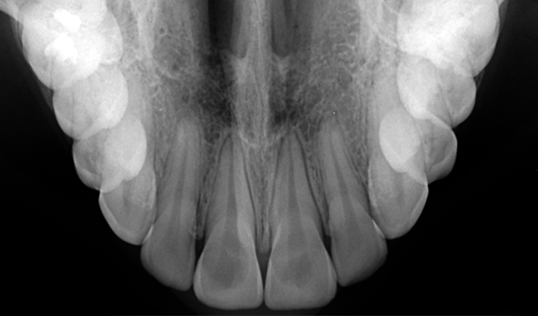 oclusal_supoclusal_inf-exame-oclusal-exame-ddi-radiografia-odontologica