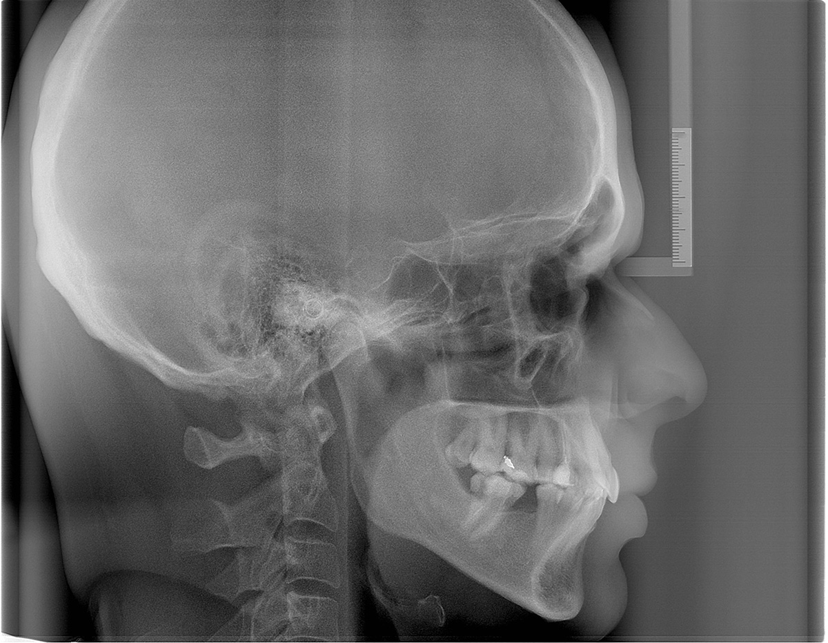 radiografia-cefalometrica-teleradiografia-lateral-ddi-exames-radiografias-odontologica